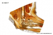 elbow_pathology_arthrosis_deformation_joint